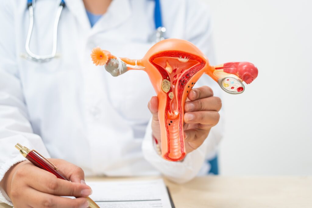 BioTE for Endometriosis